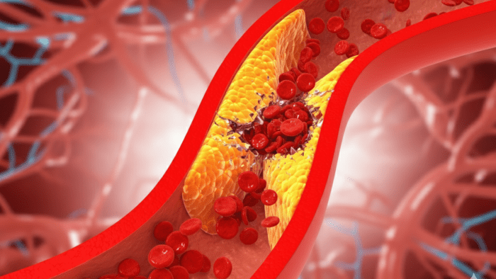 Dislipidemia atau Penyakit Kolestrol
